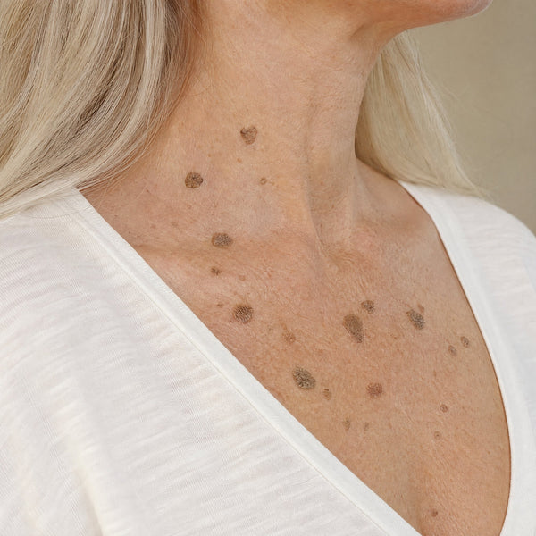Kerava Glycolic Body Stick, site area chest neck