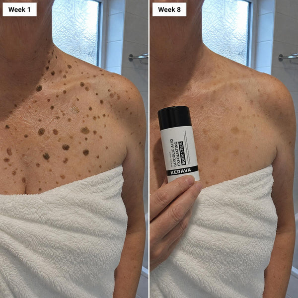Kerava Glycolic Body Stick, week1 week8